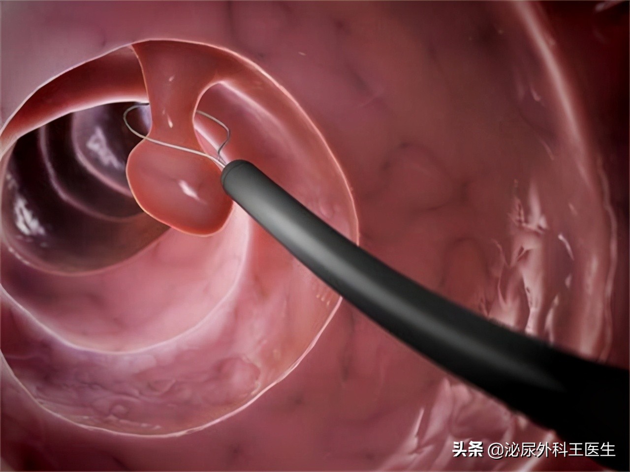 What test can find colon polyps?In addition to colonoscopy, there are