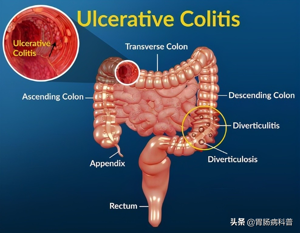 New drug for ulcerative colitis, phase 3 study was successful: the ...