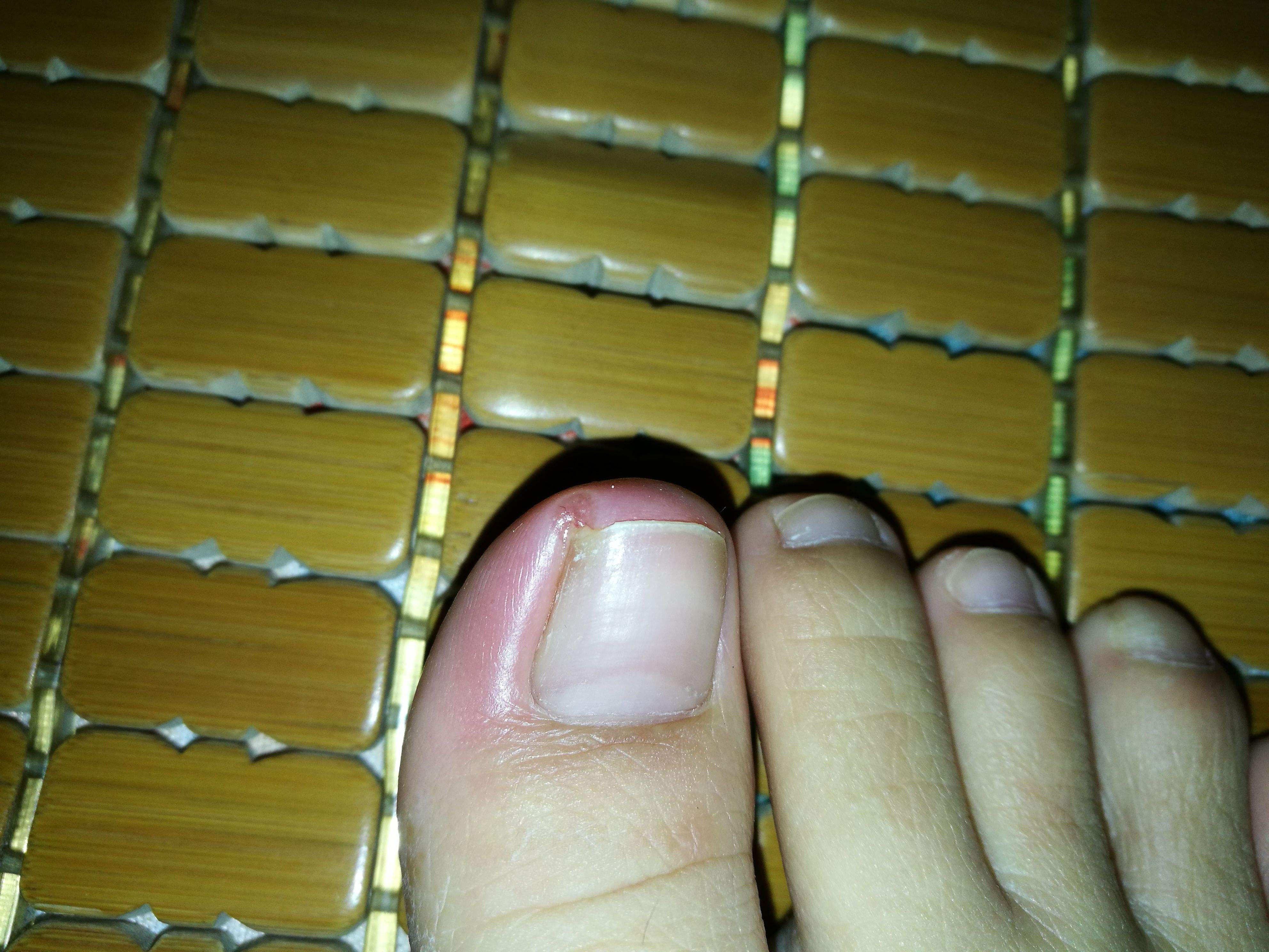 What if my nails grow into the flesh? One way to teach you to easily