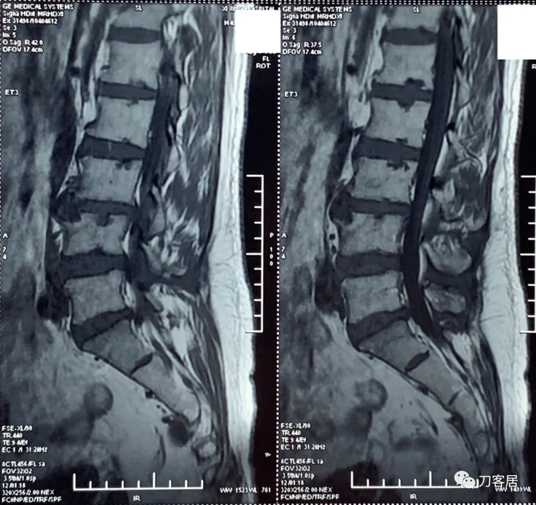 52-year-old male, lumbar 3-4 intervertebral disc herniation ...