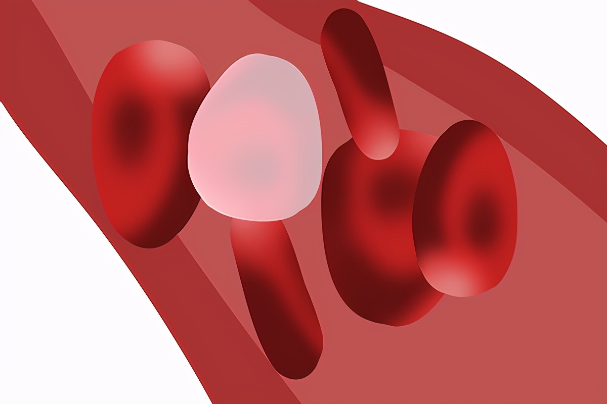 Can a cholesterol content in eggs, can't you eat in patients with hyperlipidemia? Unlike you