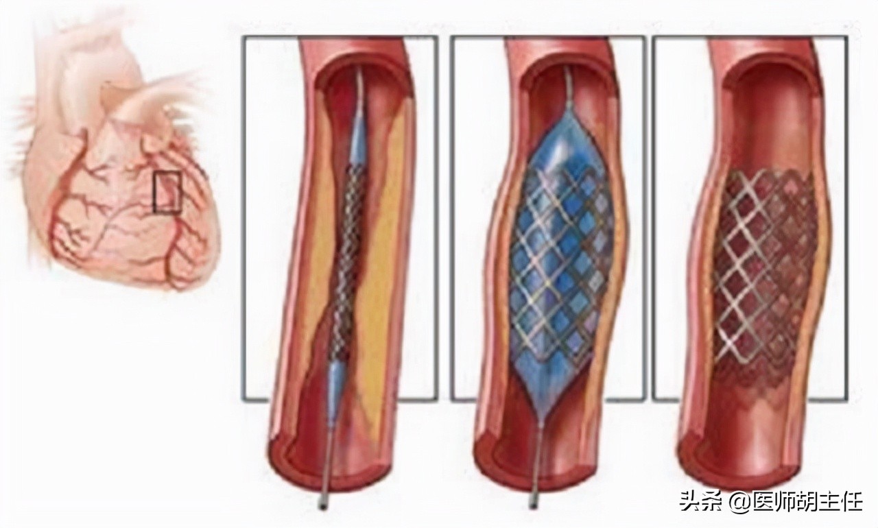 How Many Years Can You Live After A Heart Stent The Doctor Tells The