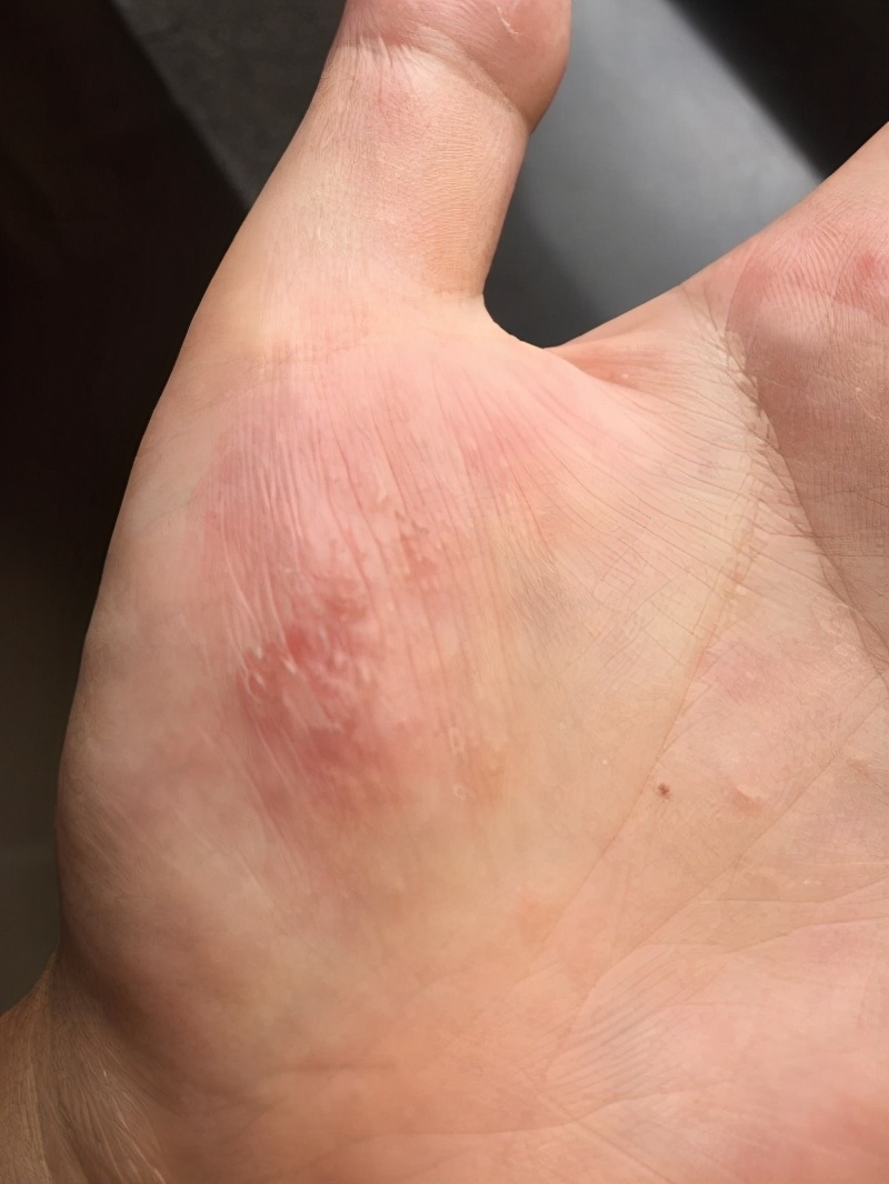 In The Summer Transparent small Blisters Appear On The Hands And In The Summer Transparent small Blisters Appear On The Hands And