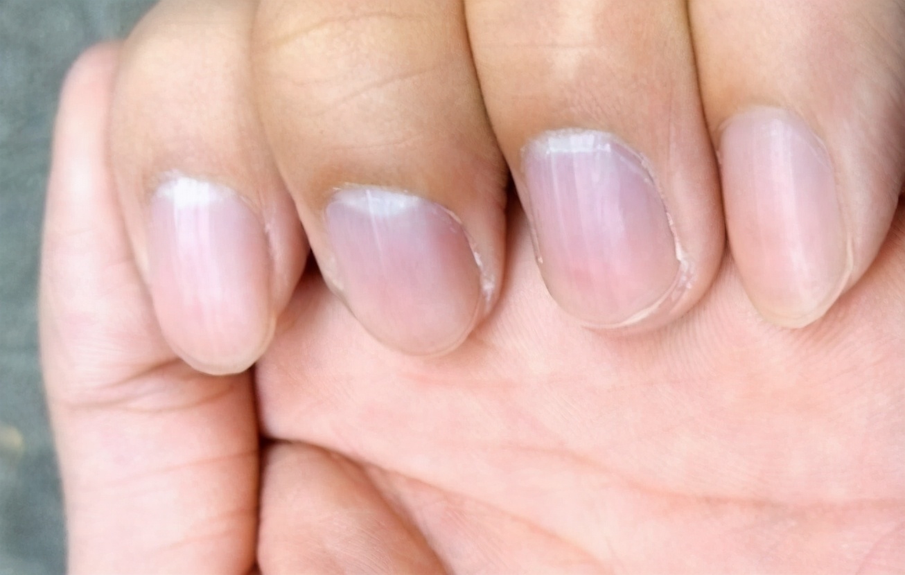 The nails are covered with vertical lines, is there a problem with the
