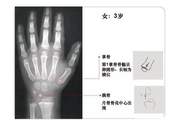 Bone Age Atlas (Revised Version) - iNEWS