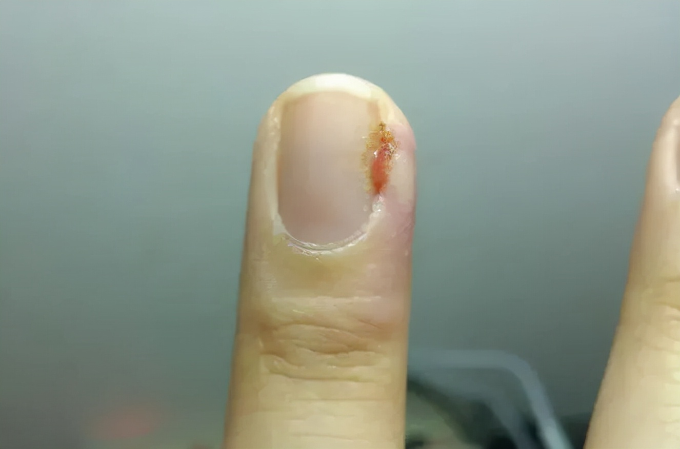 What should I do if I have a "barb" on my finger?Why can't these barbs