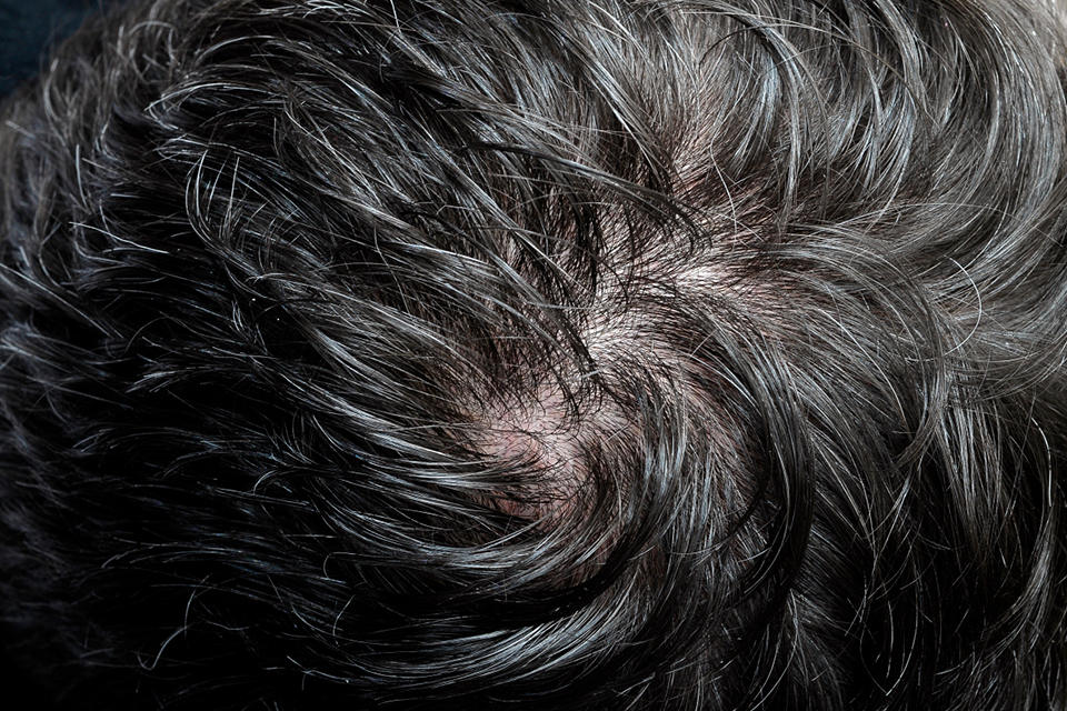 4 common hair problems and solutions, one for one year - iNEWS
