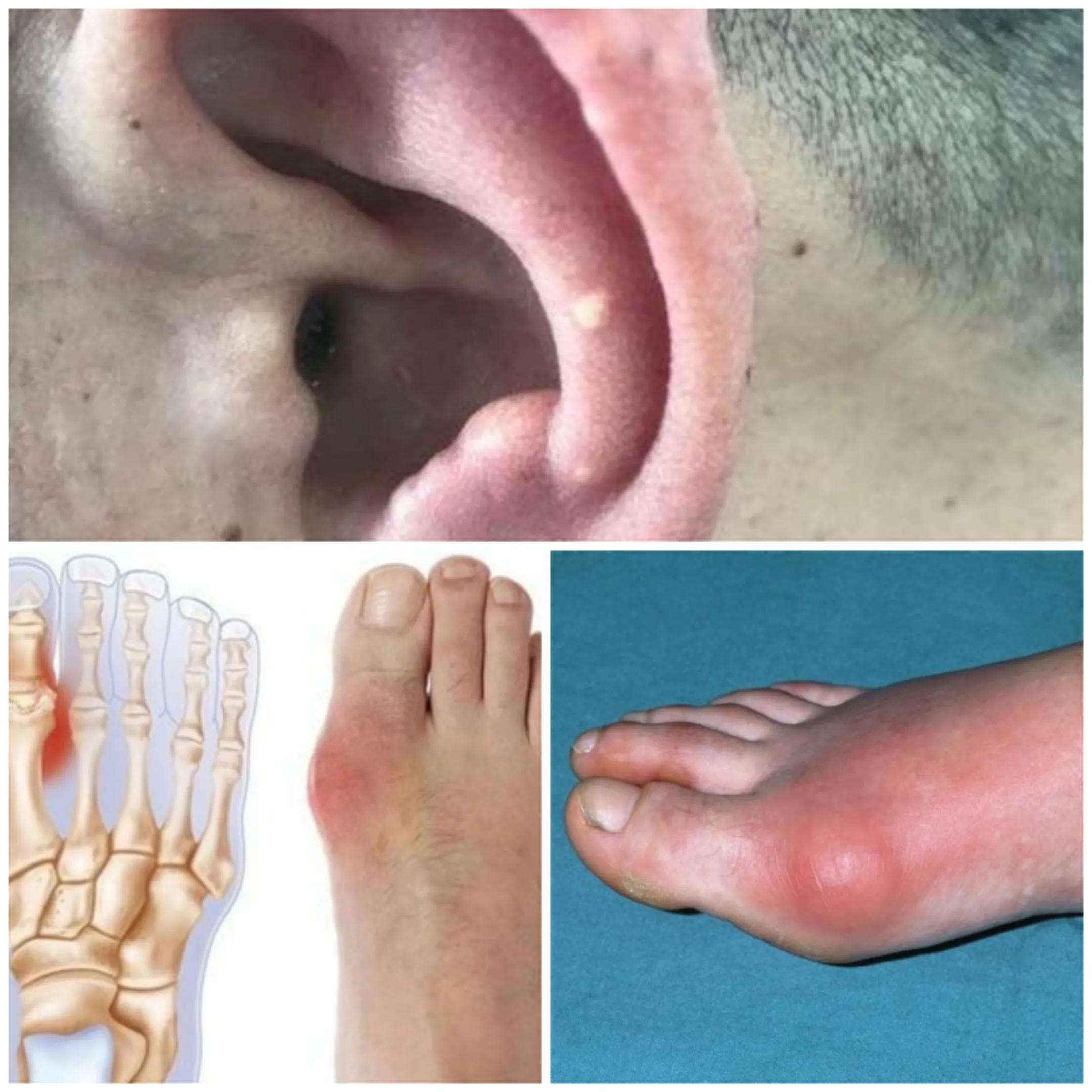 Is uric acid 700 high?How to manage? iNEWS