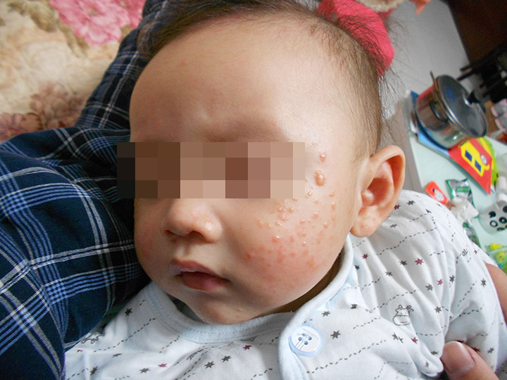 4monthold baby has eczema, novice mother "emergency medical treatment