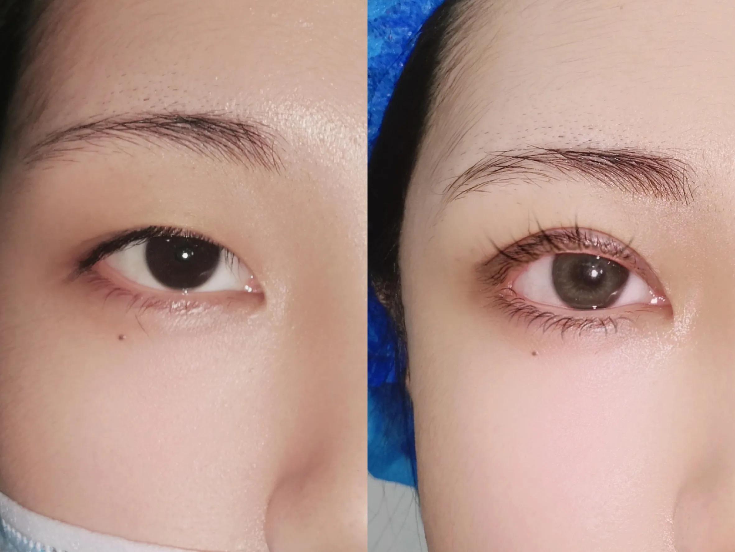 Rapid growth of double eyelid, no more incision or embedding iNEWS