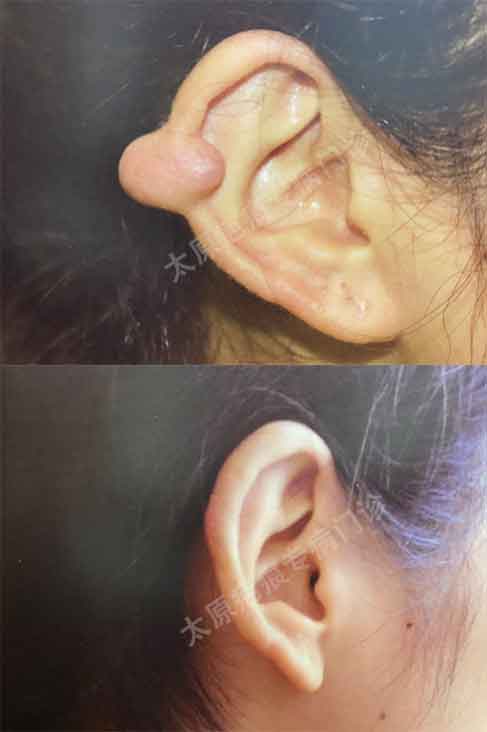 How To Save You Keloid Scars Left By Pierced Ears Inews