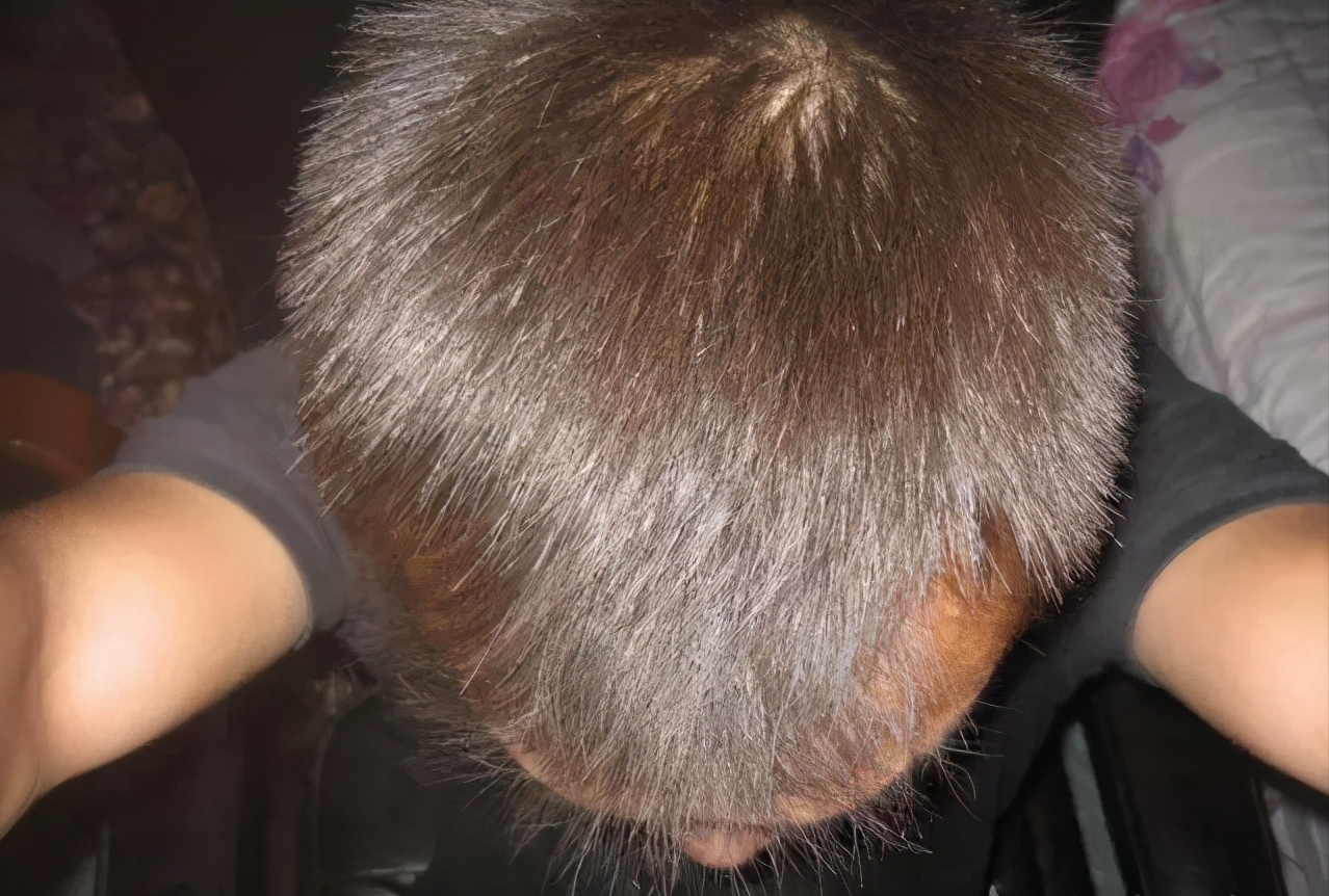 中年男人5级遗传性脱发一年之后大变身