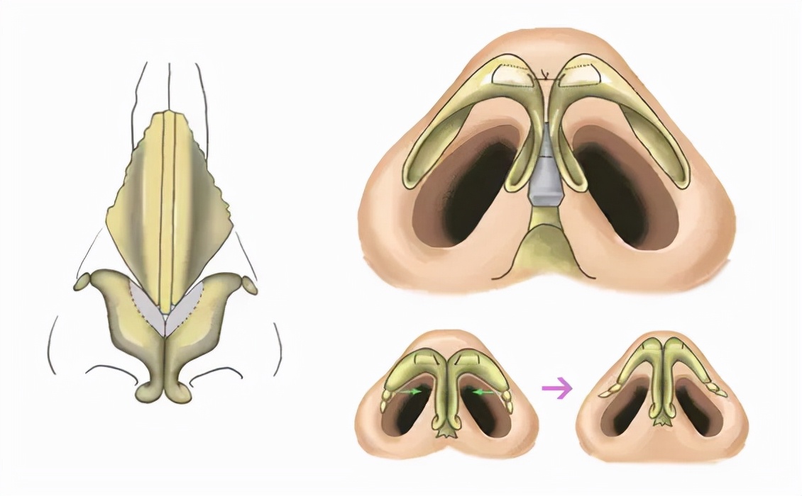 How to improve the garlic nose that expands with the expression iNEWS