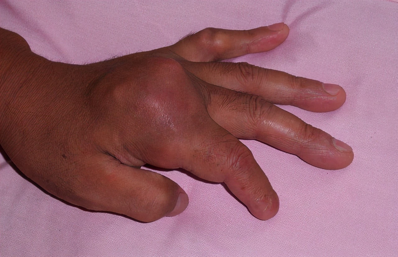 Seafood is the "culprit" of gout?Doctor People with high uric acid