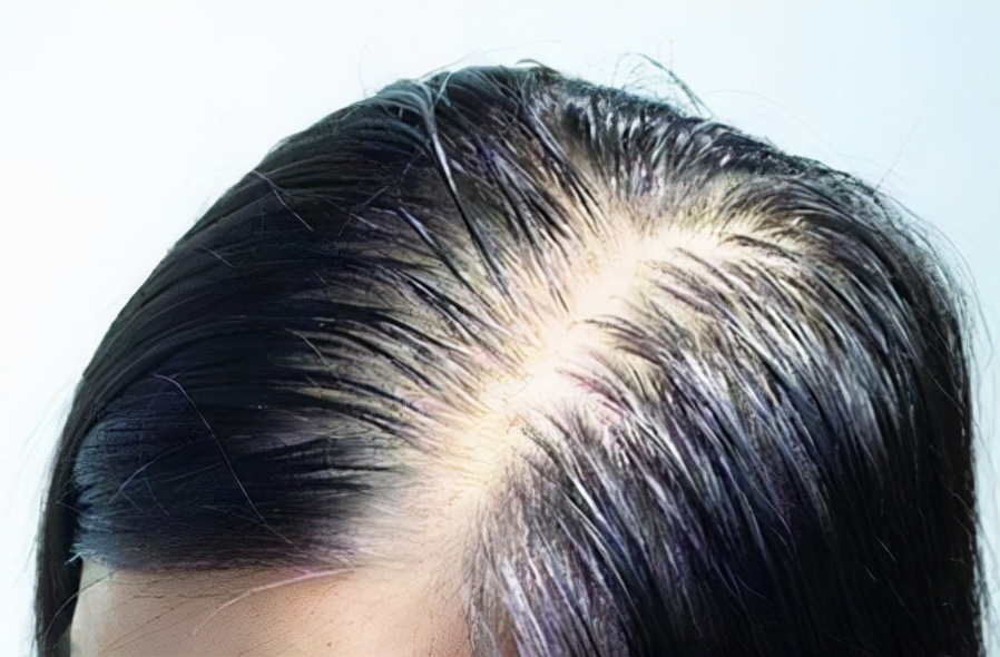 What are the reasons for oily hair, itchy scalp and hair loss during