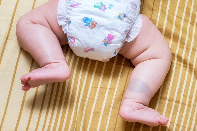 Why do many newborn babies have a "bruise" on their buttocks? Finally