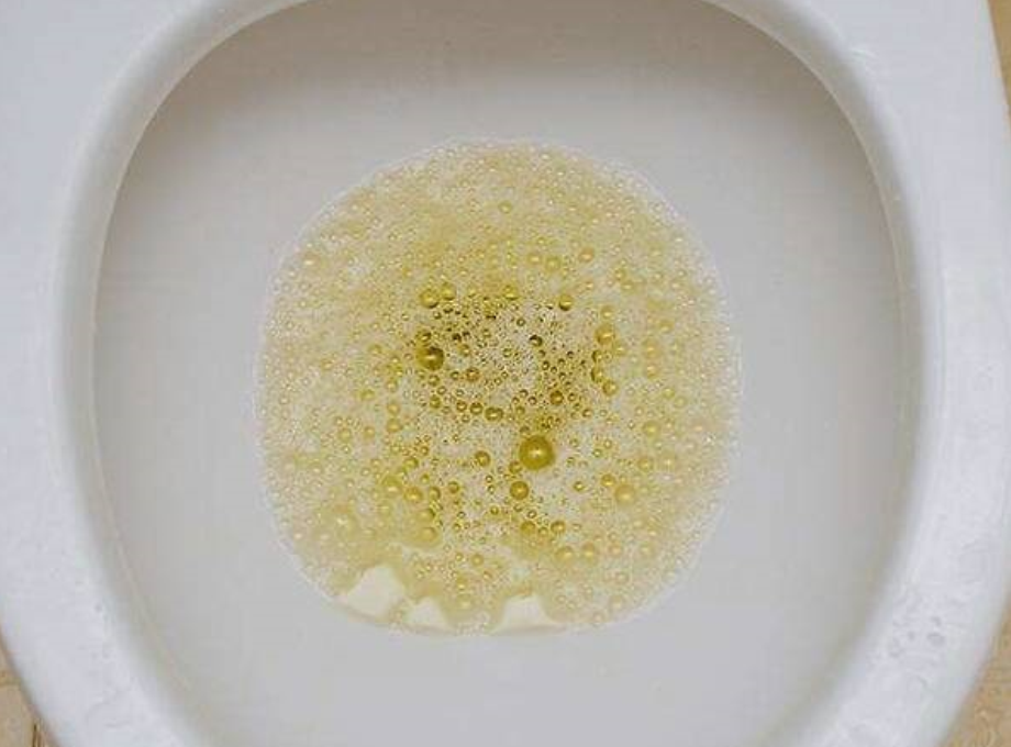 When going to the toilet, the urine is foamy. Is it proteinuria and ...