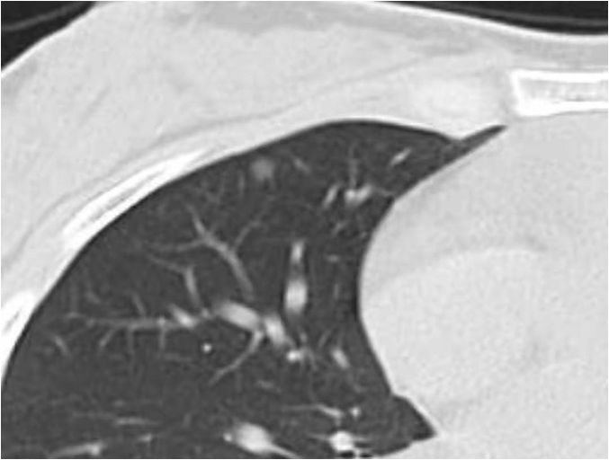 4mm ground glass lung nodule is actually "invasive adenocarcinoma"? iNEWS