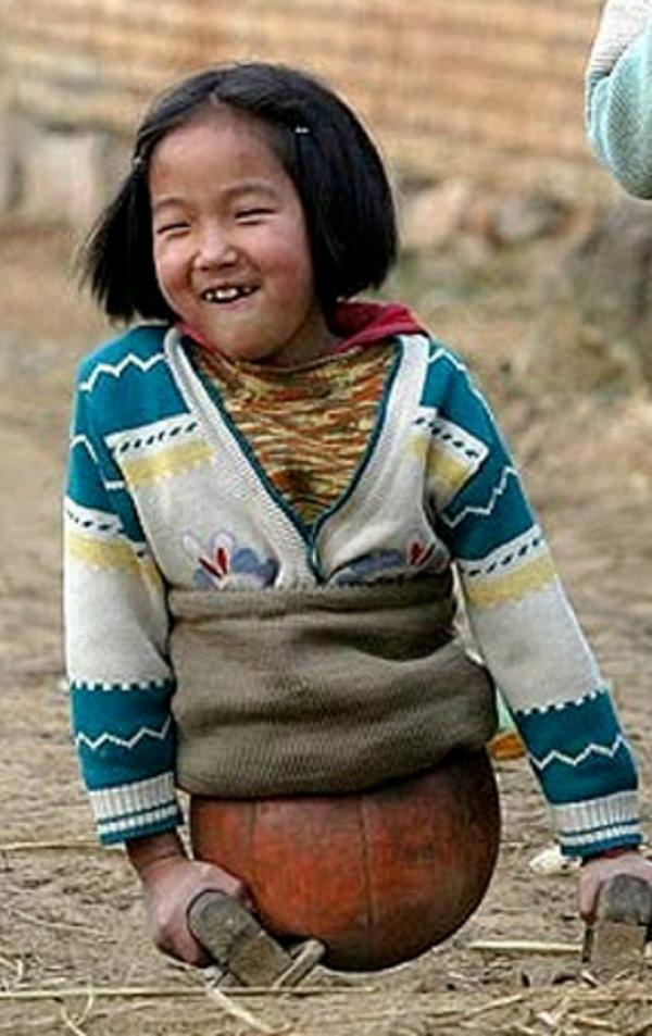 At the age of 4, he lost his legs in a car accident, but accidentally ...