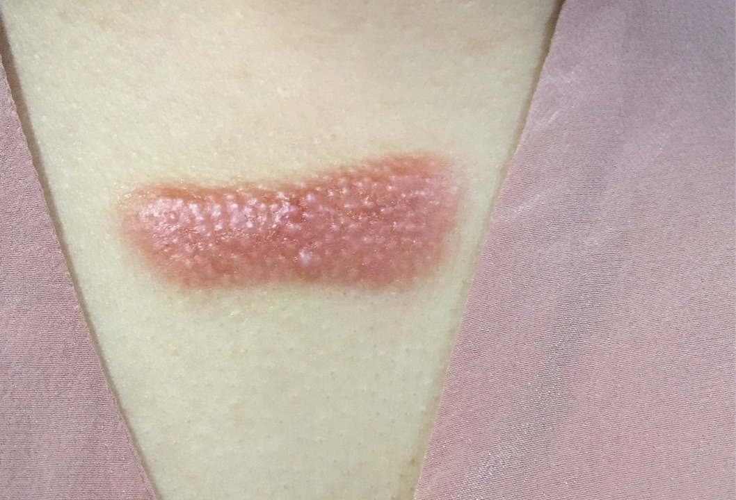 What is the solution for keloids on my chest? iNEWS